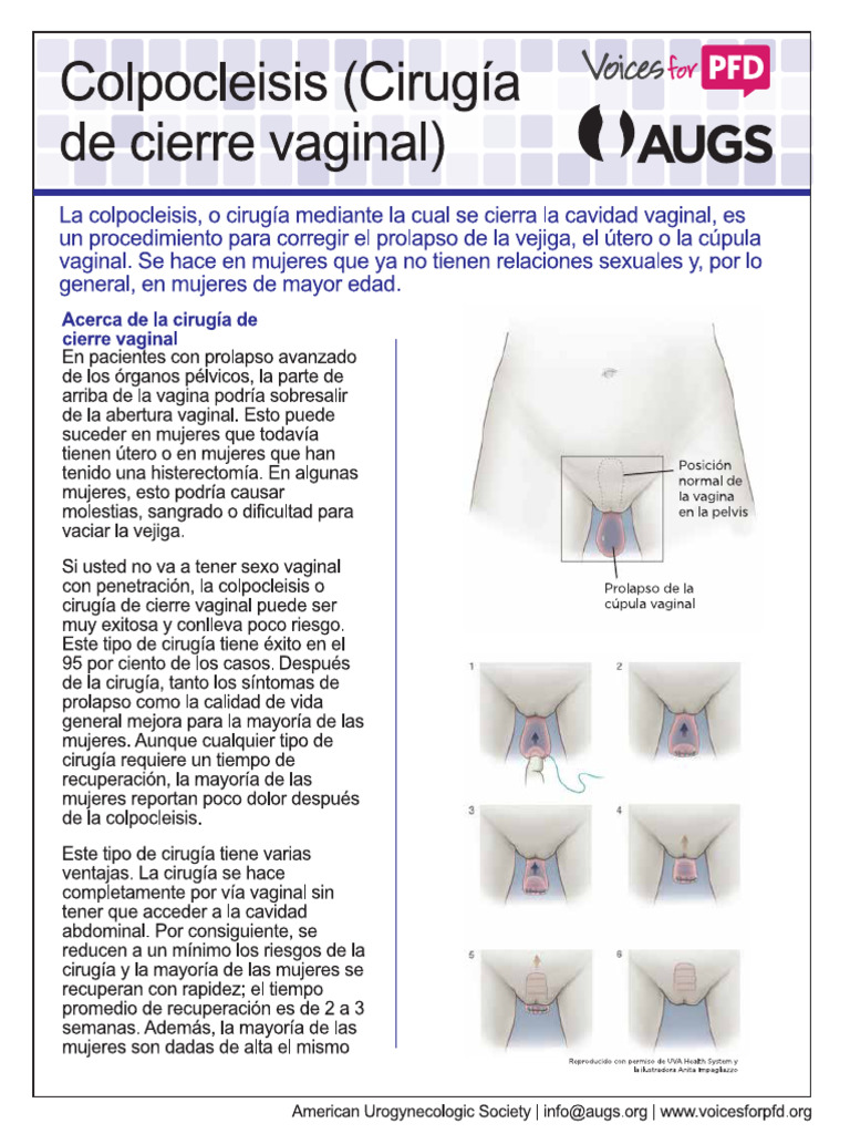 Colpocleisis Spanish | PDF