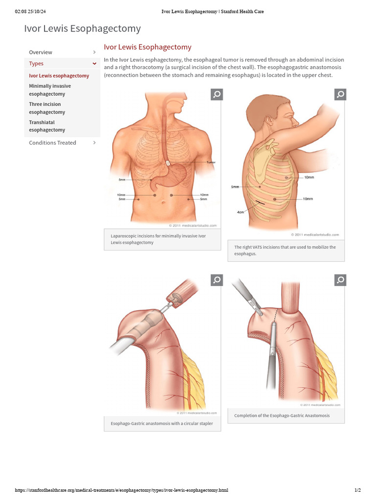 Ivor Lewis Esophagectomy Overview | PDF