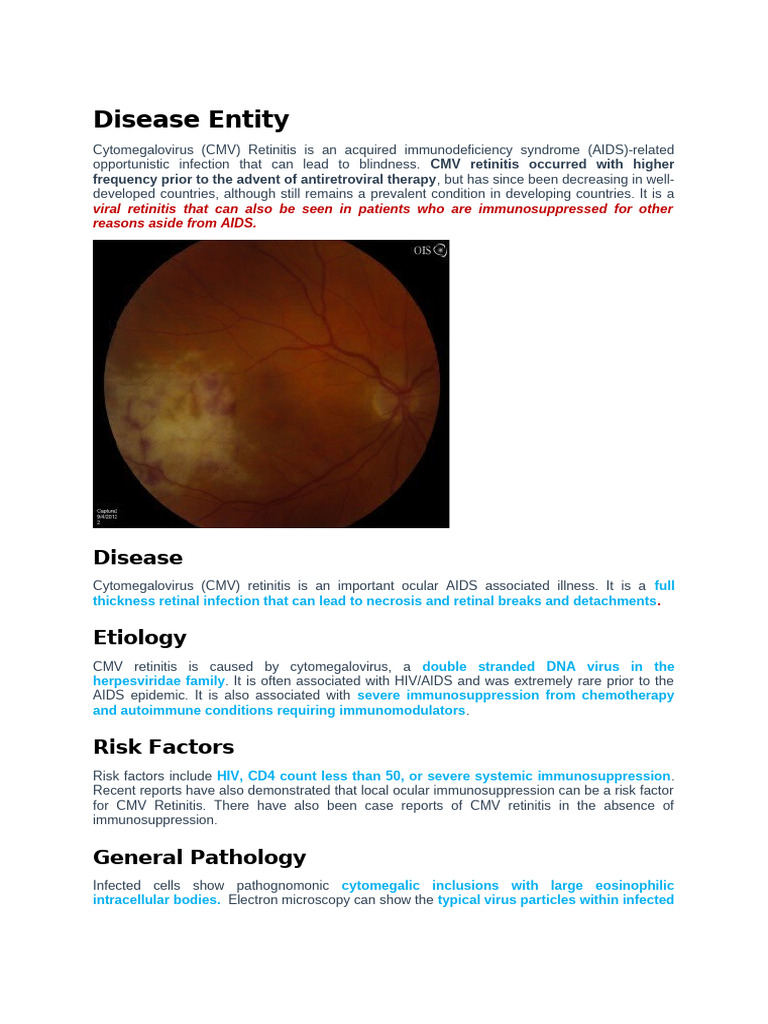 CMV Retinitis23rd June2020 | PDF | Hiv/Aids | Management Of Hiv/Aids