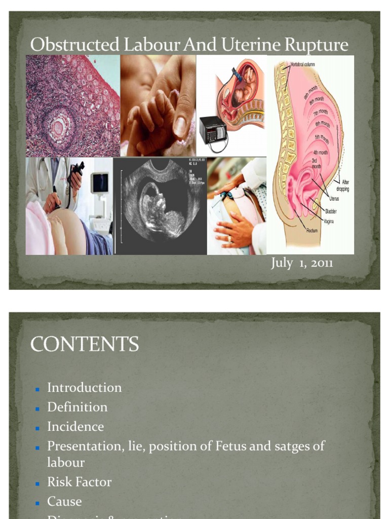 Seminar On Obstructed Labour Childbirth Pelvis