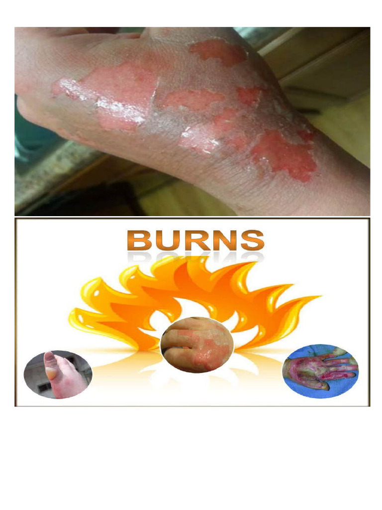 Comprehensive Guide to Burn Injuries | PDF | Burn | Skin