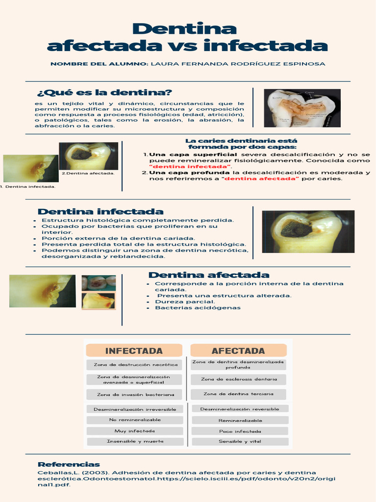 Dentina Afectada e Infectada en Caries | PDF