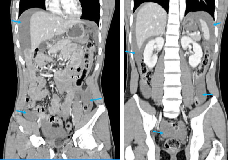 CT Blunt Trauma | PDF