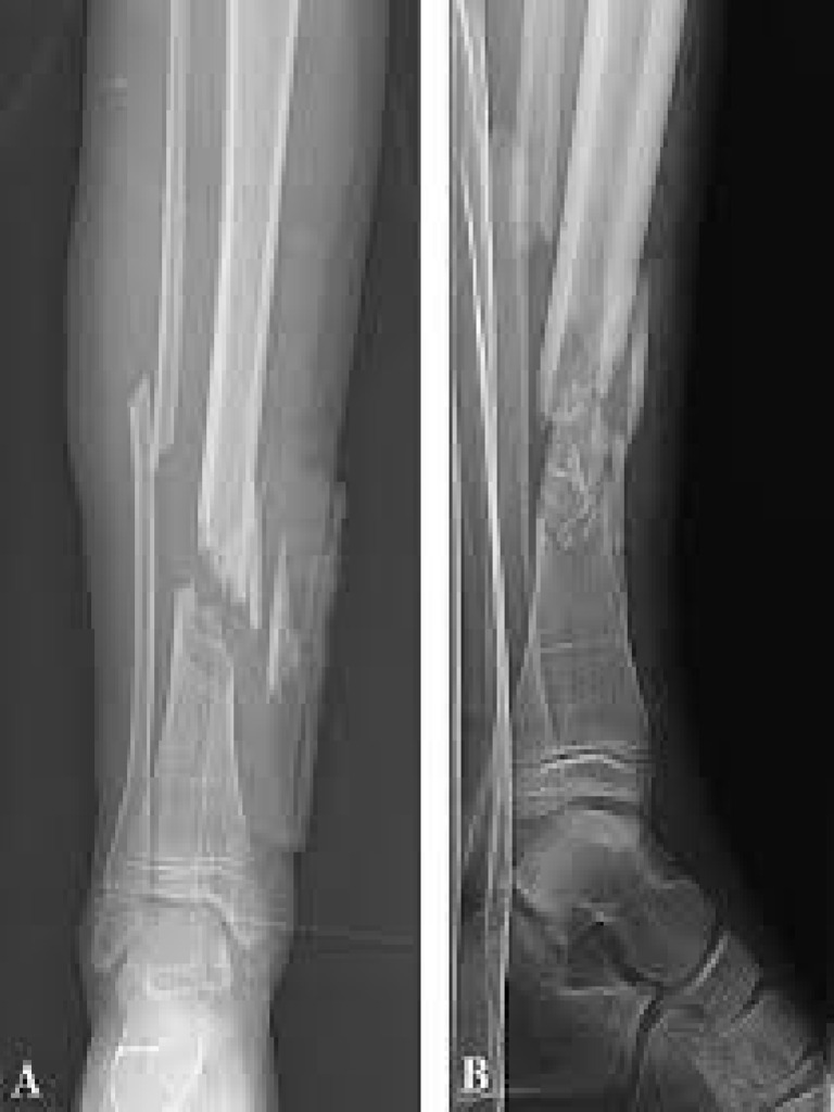 Comminuted Tib Fracture | PDF