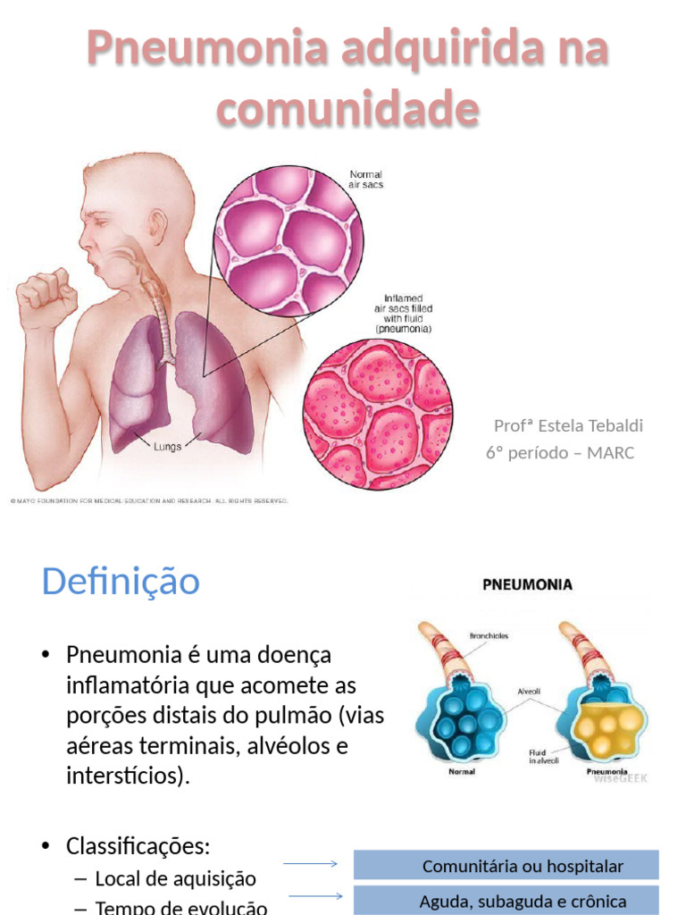 Pneumonia Adquirida na Comunidade: Guia Completo | PDF | Pneumonia ...
