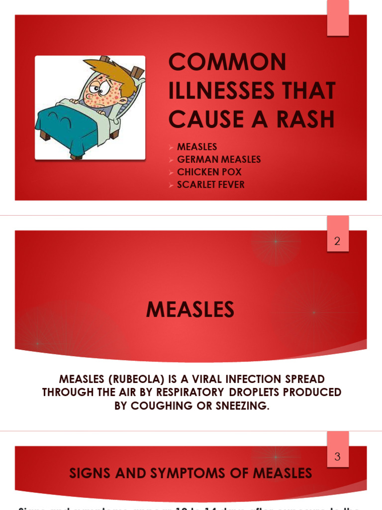 Measles and More Powerpoint 050224 | PDF | Measles | Immunology