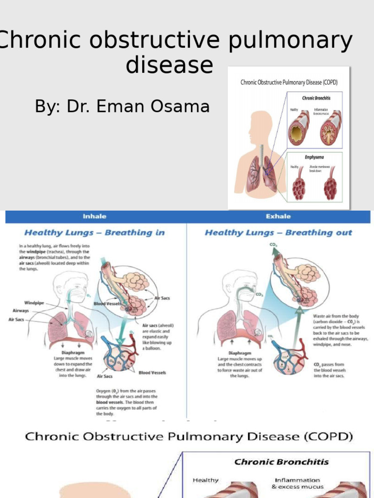 COPD_032103 | PDF | Chronic Obstructive Pulmonary Disease | Lung
