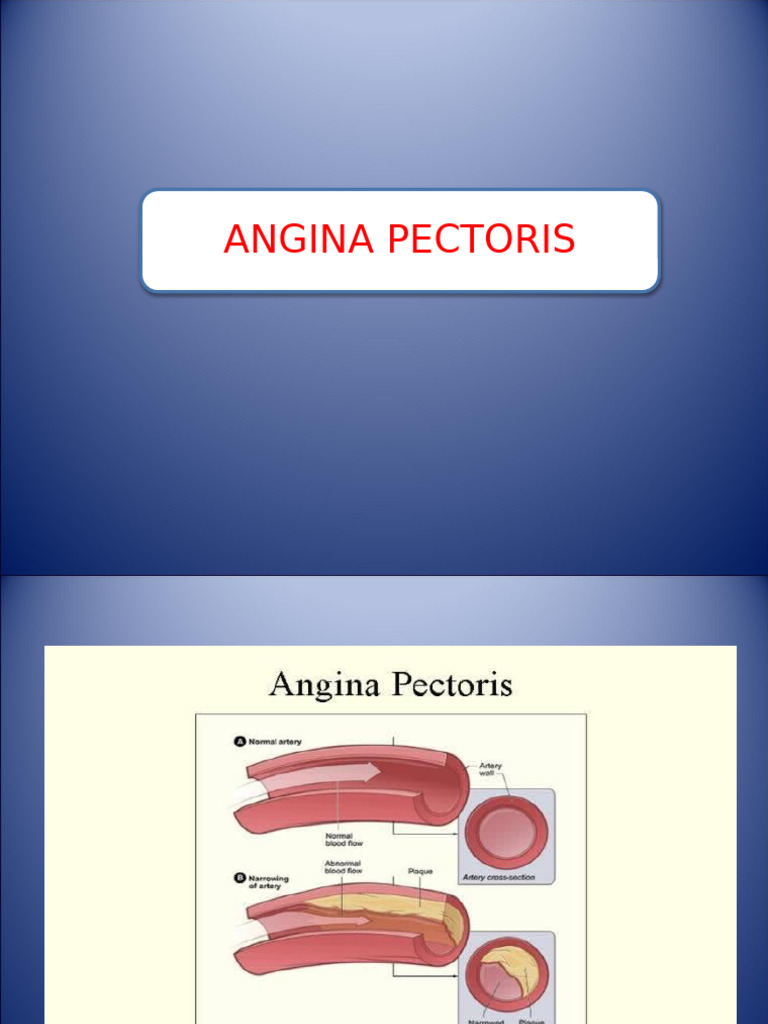 Understanding Angina Pectoris Types | PDF | Coronary Artery Disease ...