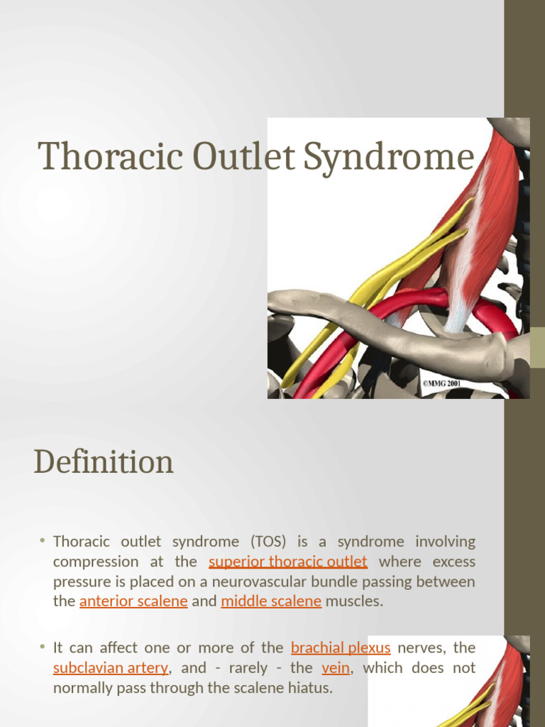 Thoracic Outlet Syndrome | PDF | Musculoskeletal System | Human Anatomy