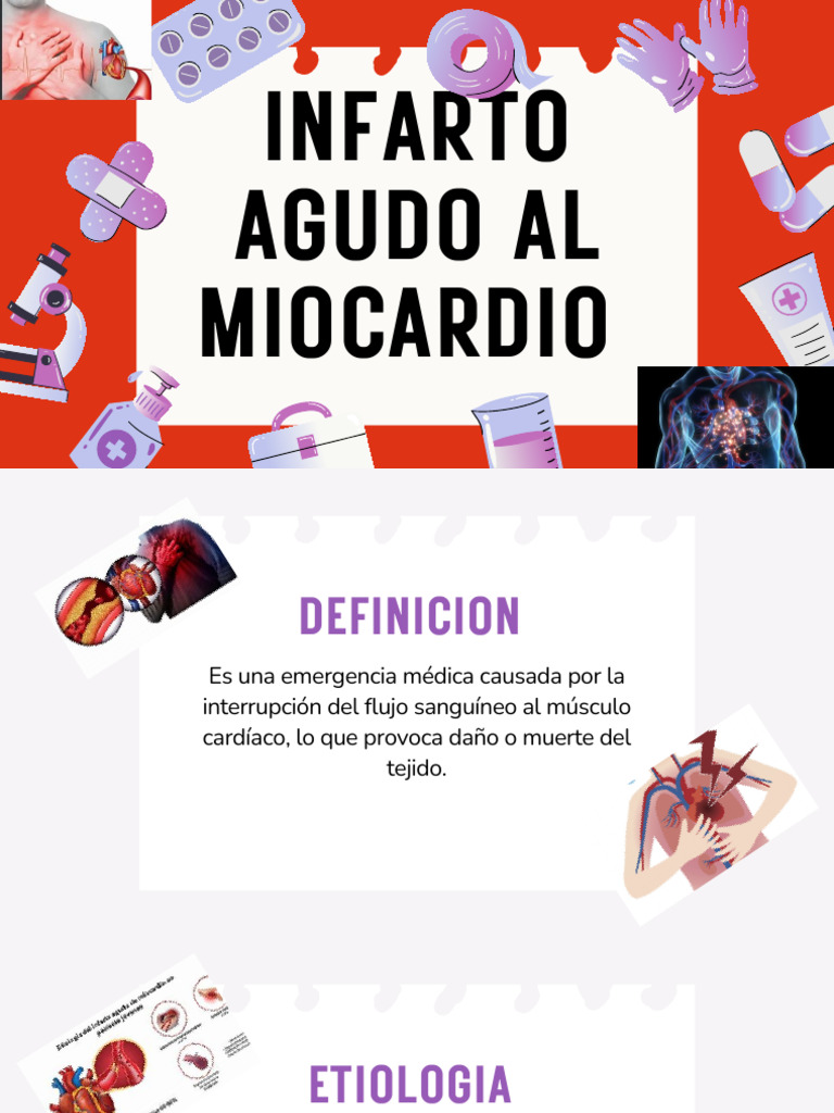 Infarto Agudo al Miocardio: Causas y Tratamiento | PDF | Infarto de ...