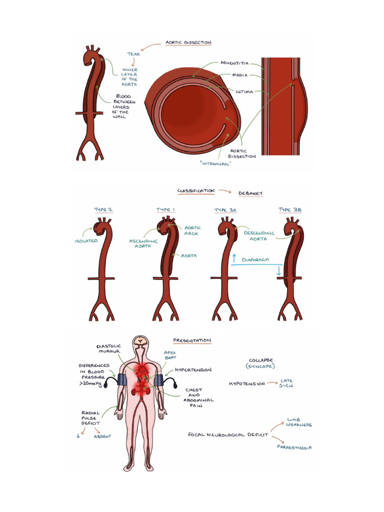 Aortic Dissection | PDF