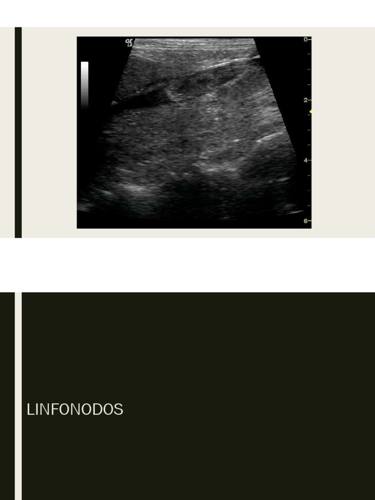 Linfonodos | PDF
