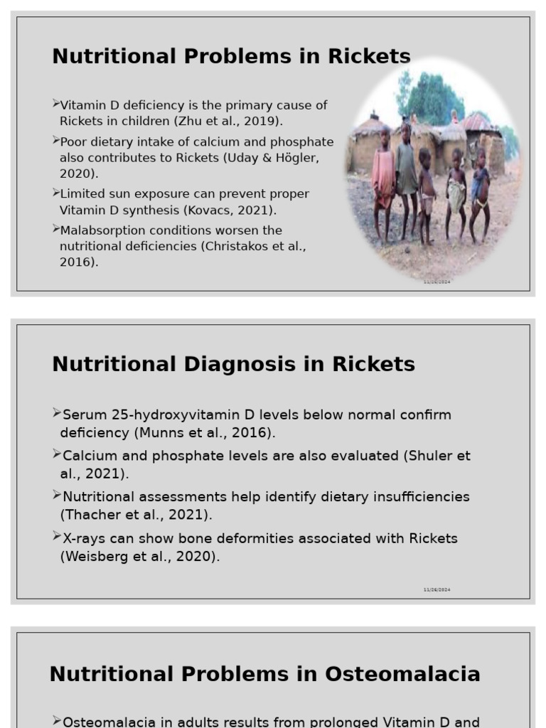Nutritional Rickets and Osteomalacia Guide | PDF | Vitamin D | Vitamin