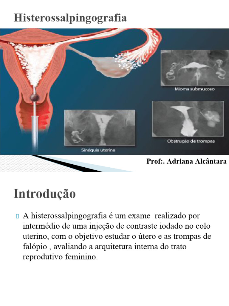 Histerossalpingografia e Prova de Cotté | PDF