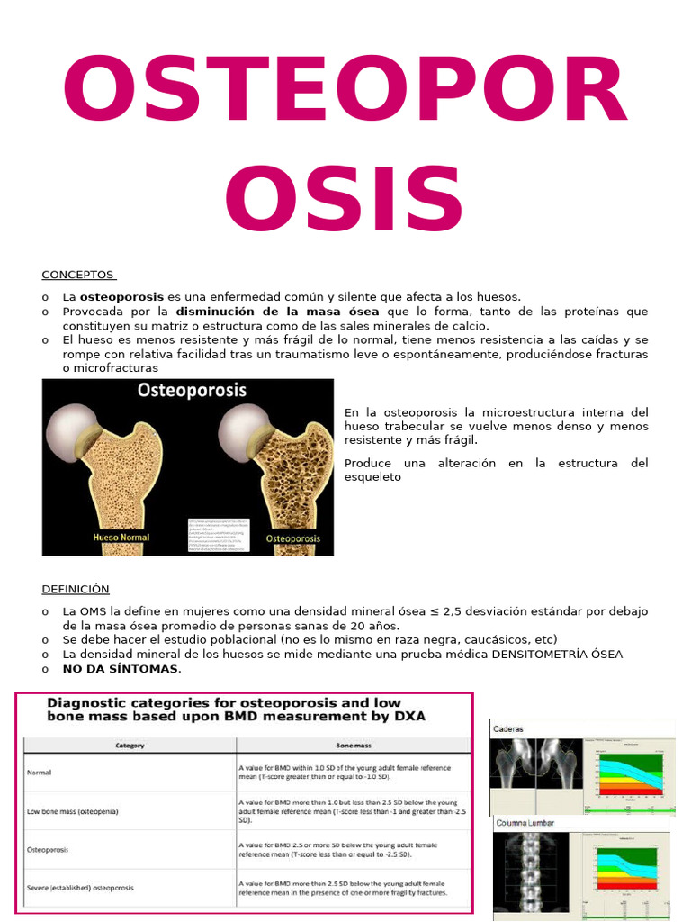 Guía Completa sobre Osteoporosis | PDF | Osteoporosis | Hueso