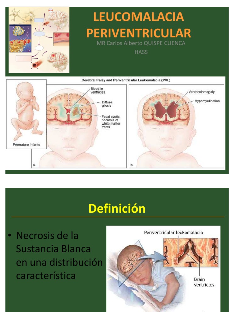 Leucomalacia Periventricular
