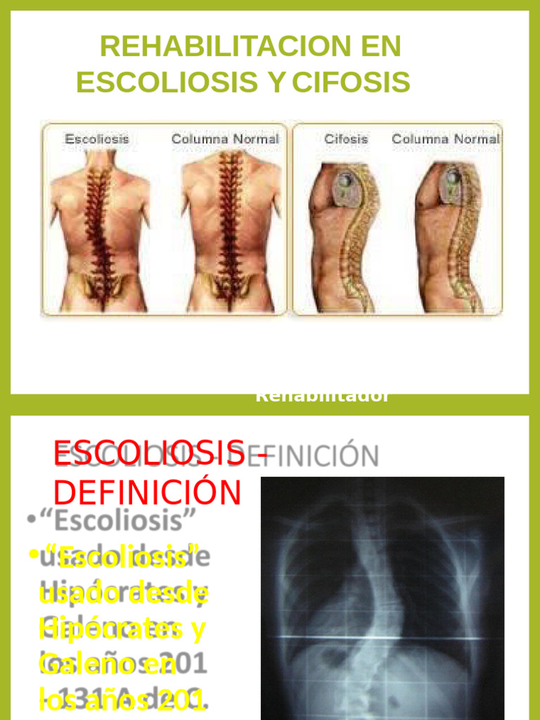 Rehabilitación en Escoliosis y Cifosis .... | PDF | Escoliosis | La ...