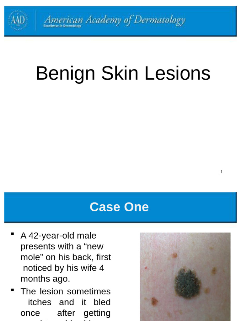 Benign Skin Lesions 5 Nov 2018 | PDF | Cutaneous Conditions | Skin