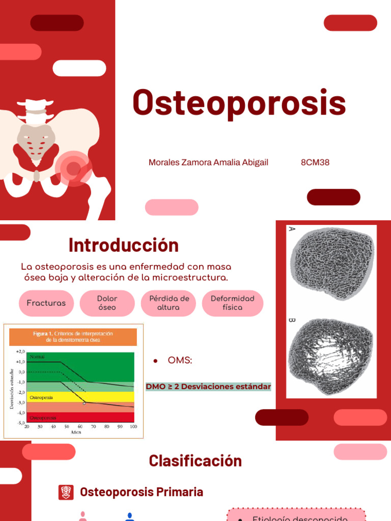 Guía Completa sobre Osteoporosis | PDF | Osteoporosis | Especialidades ...