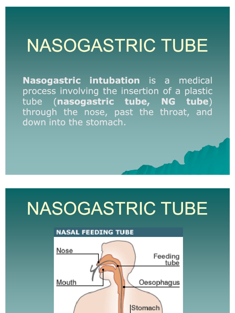 Nasogastric Tube PDF Gastroenterology Medical Specialties
