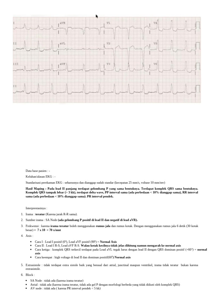 Interpretasi EKG: Sinus Ritme & WPW | PDF