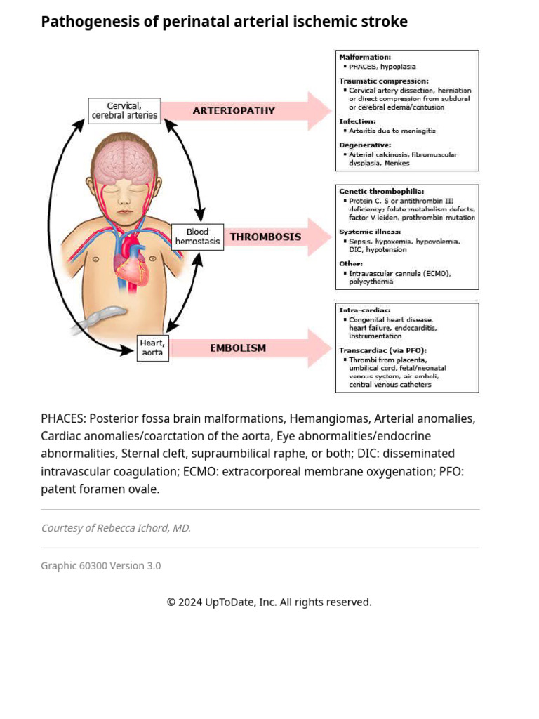 Perinatal Arterial Ischemic Stroke Pathogenesis | PDF