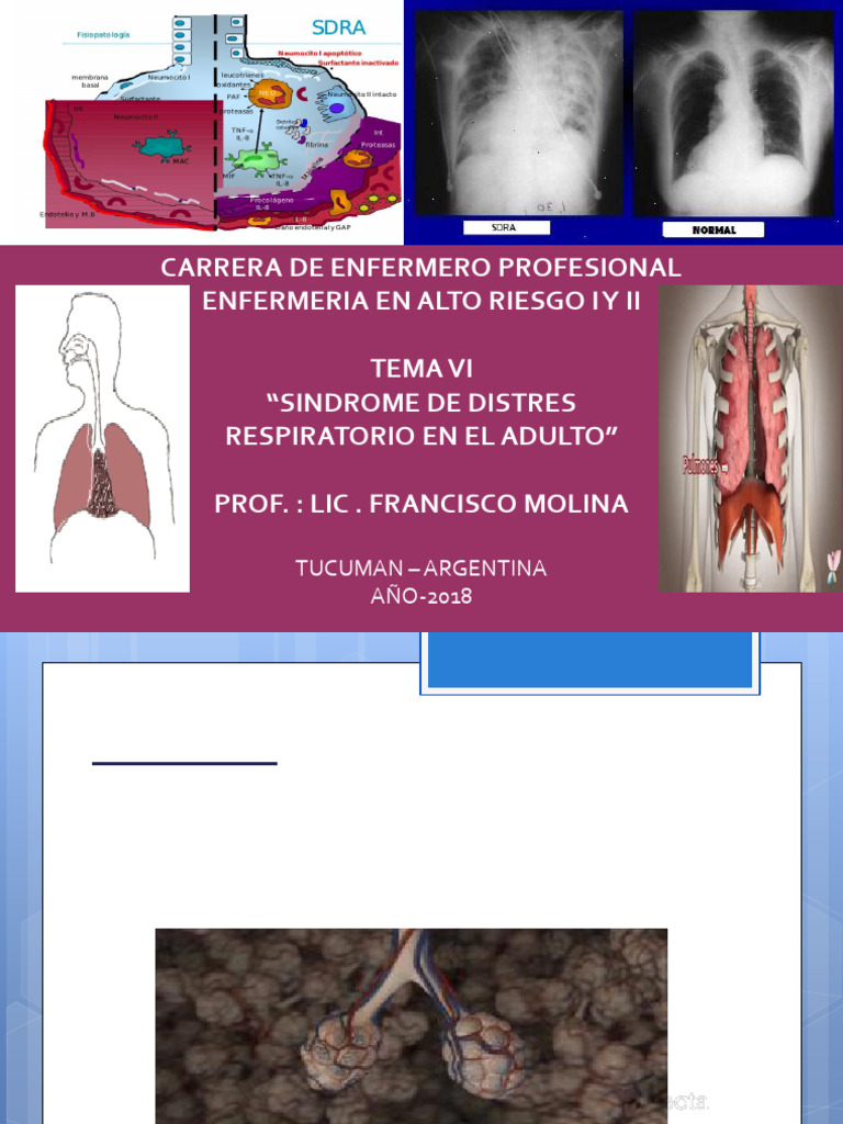 Tema 6 Sdra Alto Riesgo | PDF | Edema | Enfermedades y trastornos