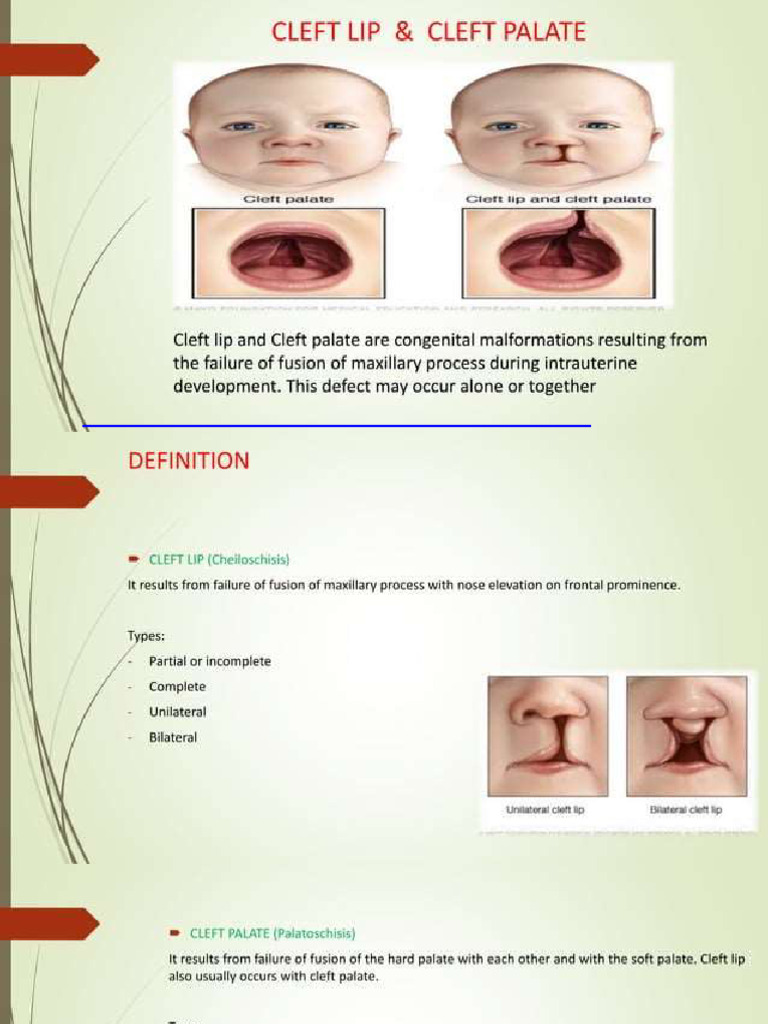 Clift lip and palate | PDF