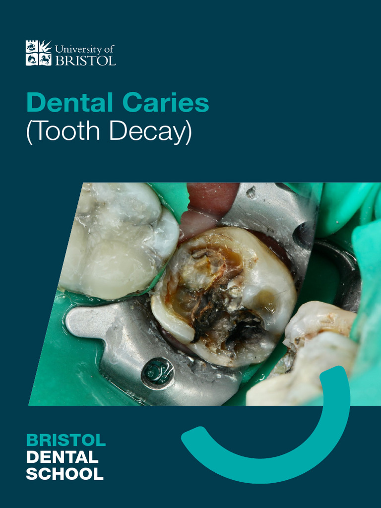 Dental Caries Tooth Decay Patient Information | PDF | Oral Hygiene ...