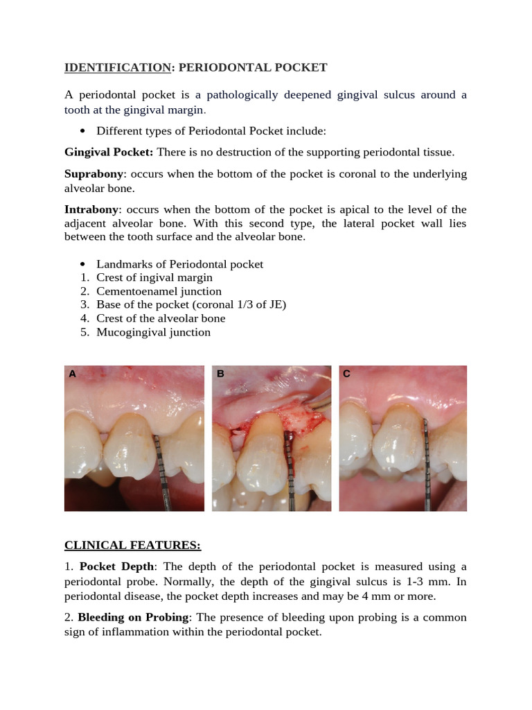 Understanding Periodontal Pockets | PDF | Periodontology | Clinical ...