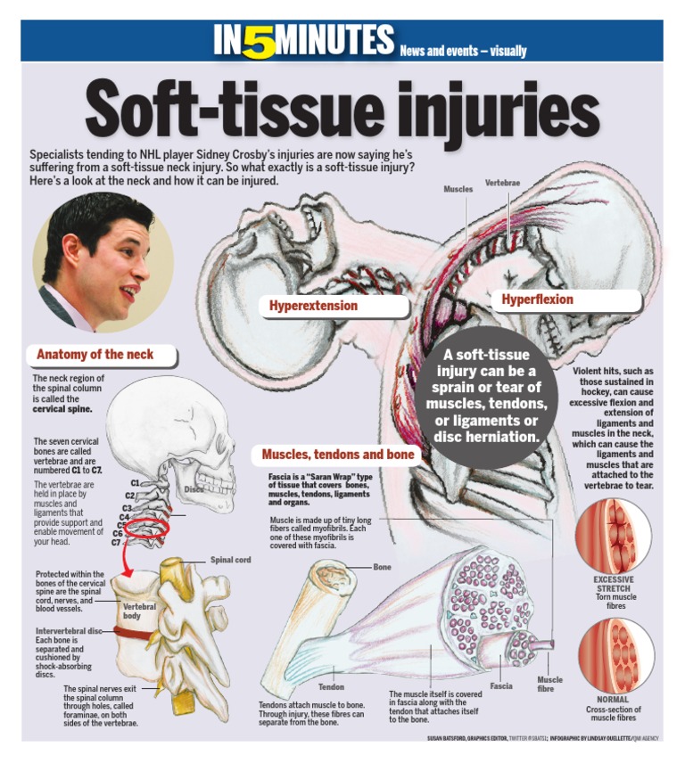 Infographic SoftTissue Injuries PDF
