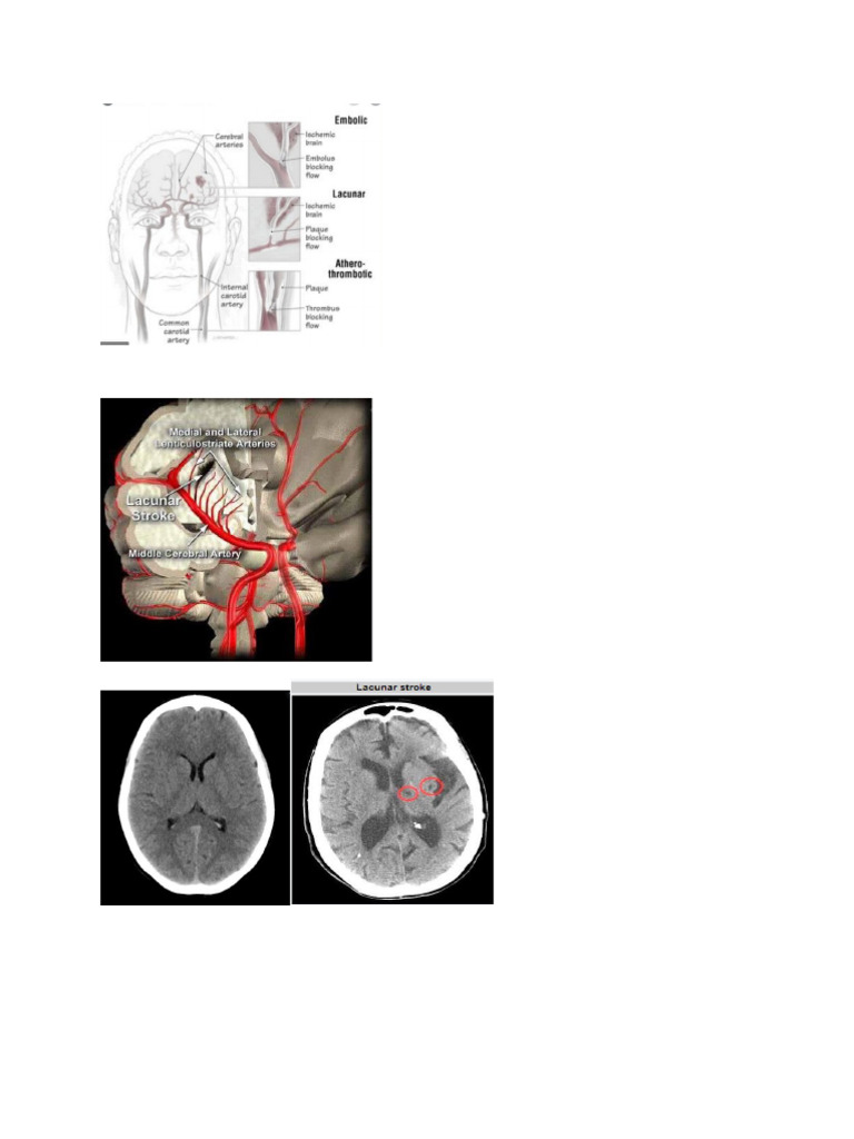 CT Scan Stroke Lacunar | PDF