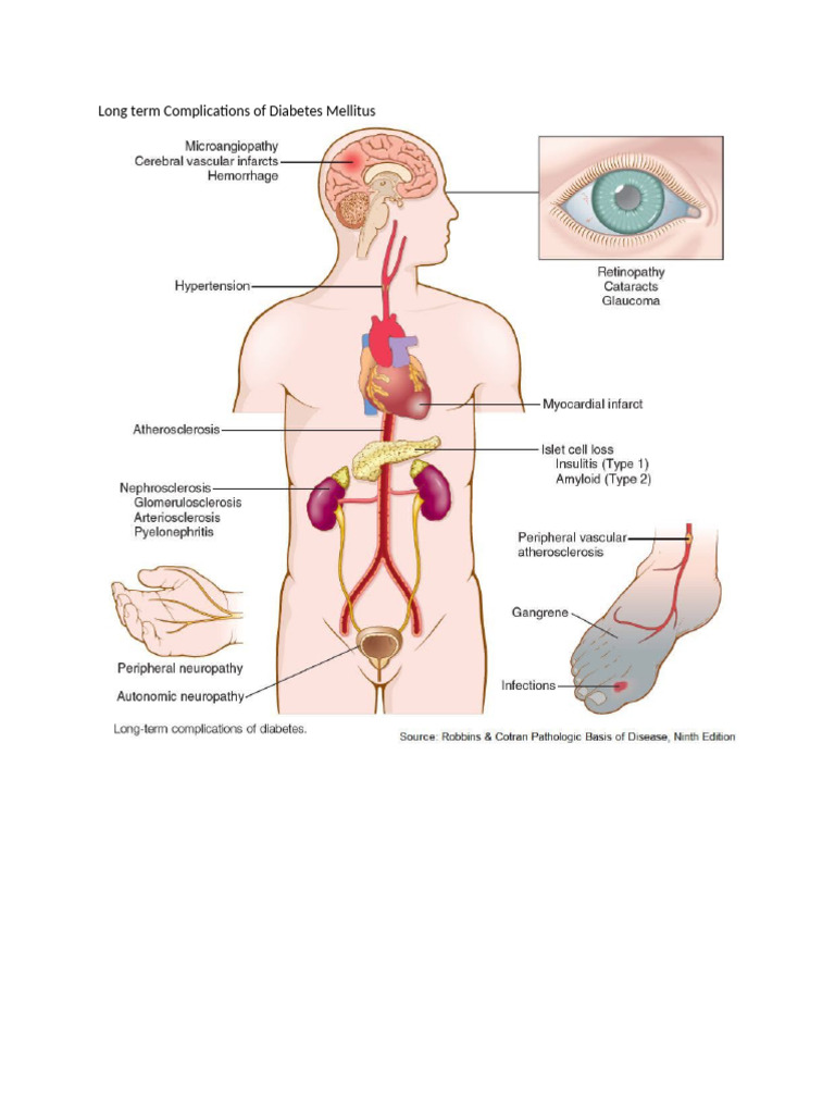 Long Term Complications of Diabetes Mellitus | PDF