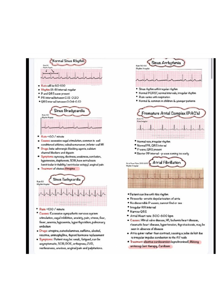 EKG Rythms Part 1 | PDF