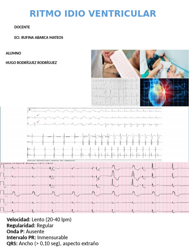 Ritmo Idioventricular Acelerado (RIVA) | PDF | Especialidades Medicas ...