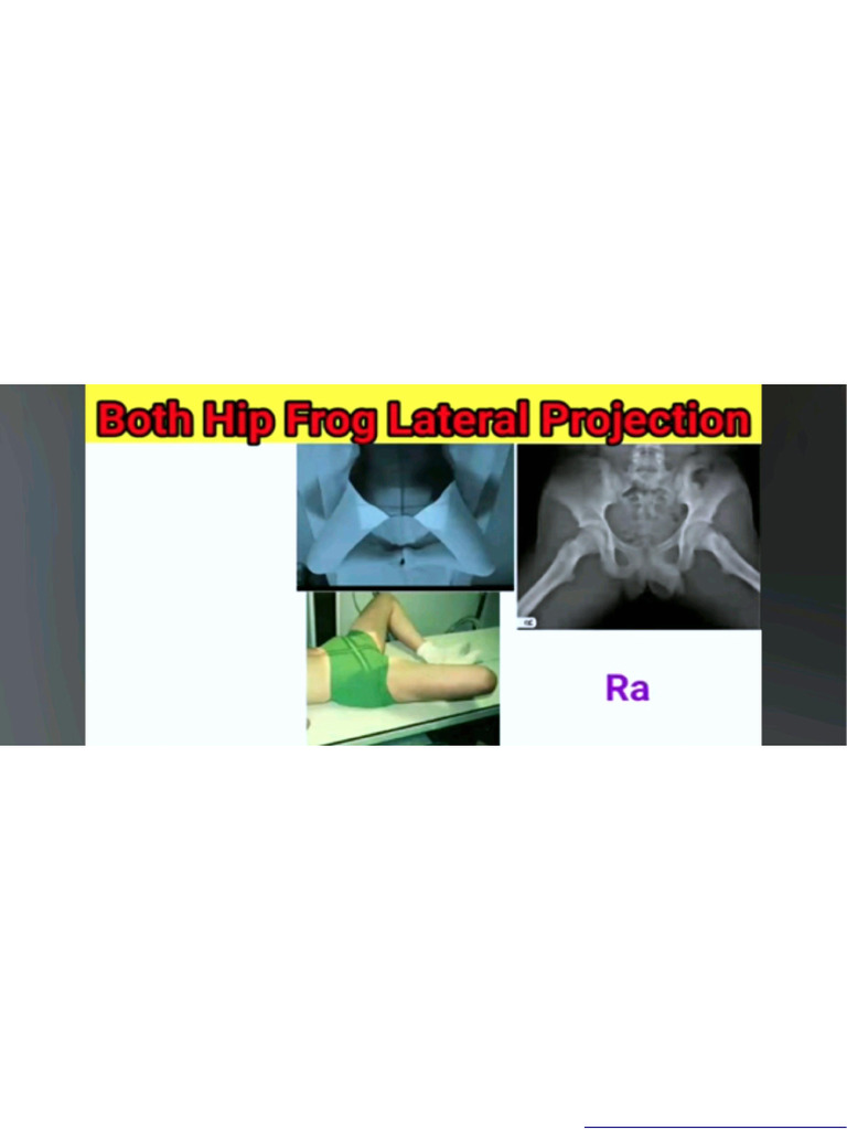 Both Hip (Frog View) | PDF