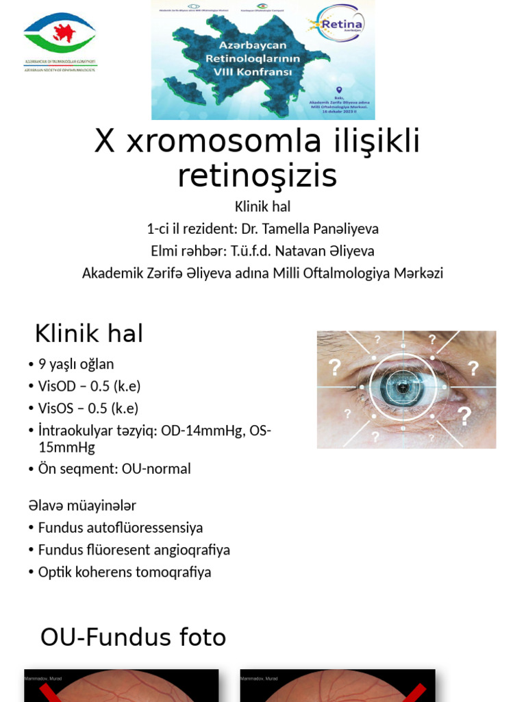x Linked Retinoschisis | PDF