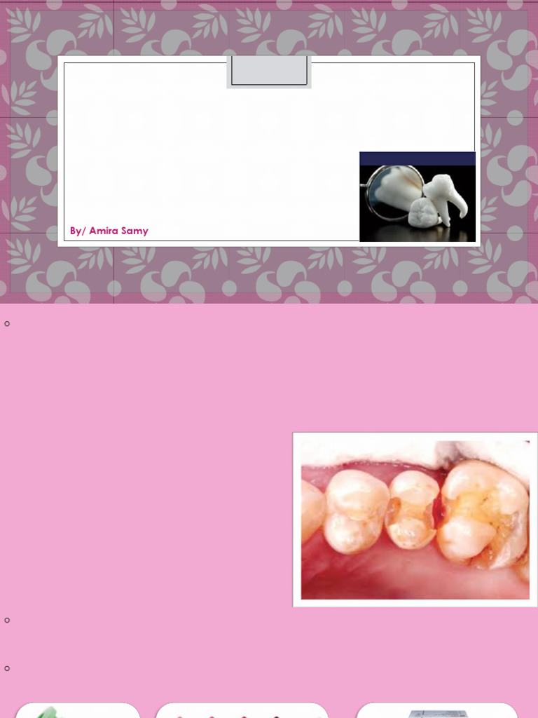 Selection of Restoration | PDF | Dental Composite | Human Tooth