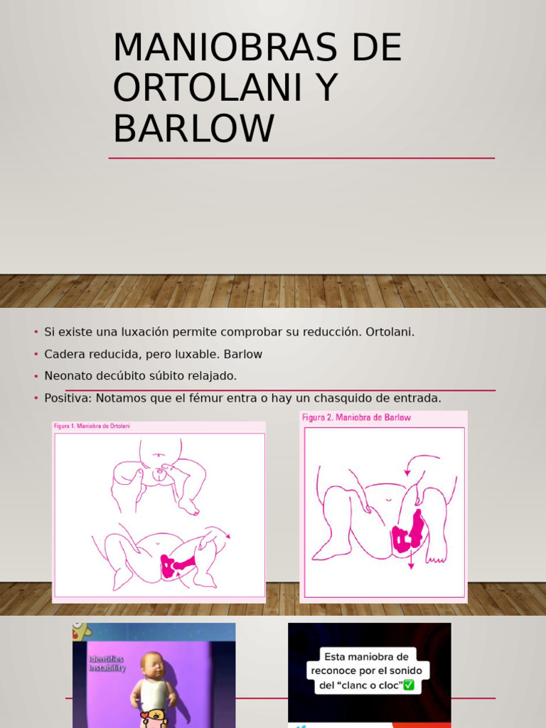 Maniobras de Ortolani y Barlow en Neonatos | PDF