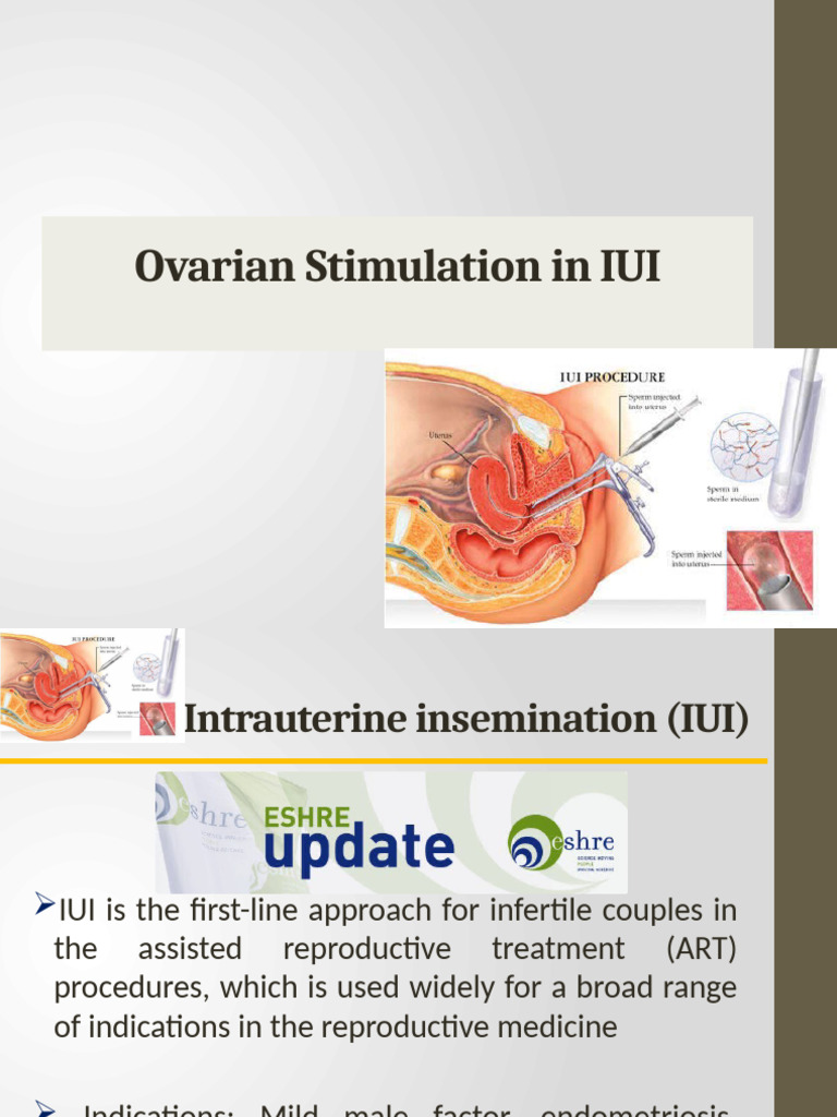 Ovarian Stimulation for IUI Success | PDF | Infertility | Fertility