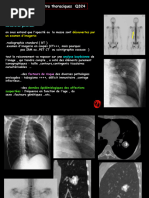 Comprendre le bronchogramme aérique | PDF | Système respiratoire | Thorax