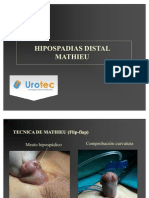 Uretroplastia Distal Mathieu