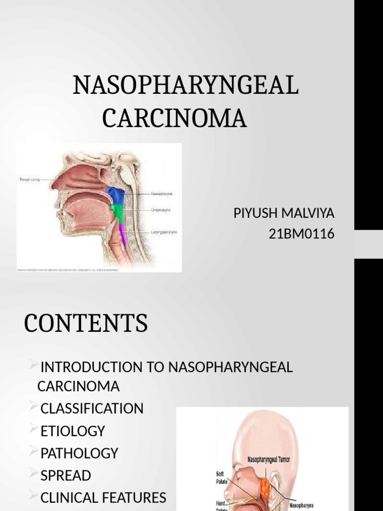 Nasopharyngeal Carcinoma Overview | PDF | Radiation Therapy | Carcinoma