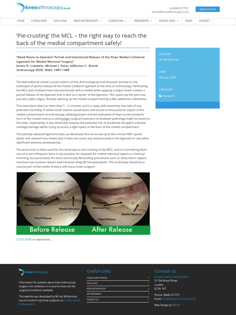 'Pie-Crusting' The MCL - The Right Way To Reach The Back of The Medial ...
