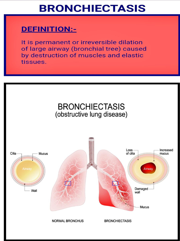 Bronchiectasis | PDF | Lung | Respiratory Tract