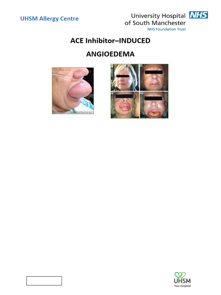 ACE Inhibitor-Induced Angioedema Guide | PDF
