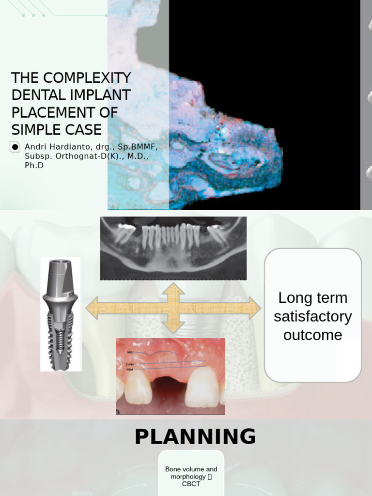 Nasopalatine Implant Placement Guide | PDF | Dental Implant | Medical ...