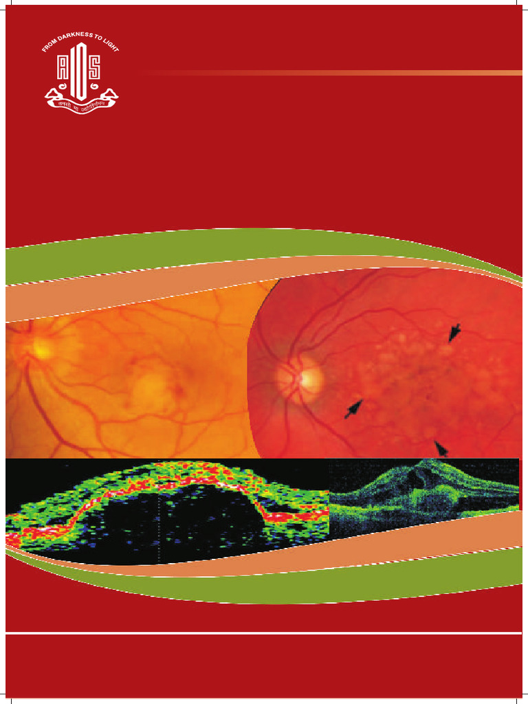 Age Related Macular Degeneration | PDF | Retina | Ophthalmology