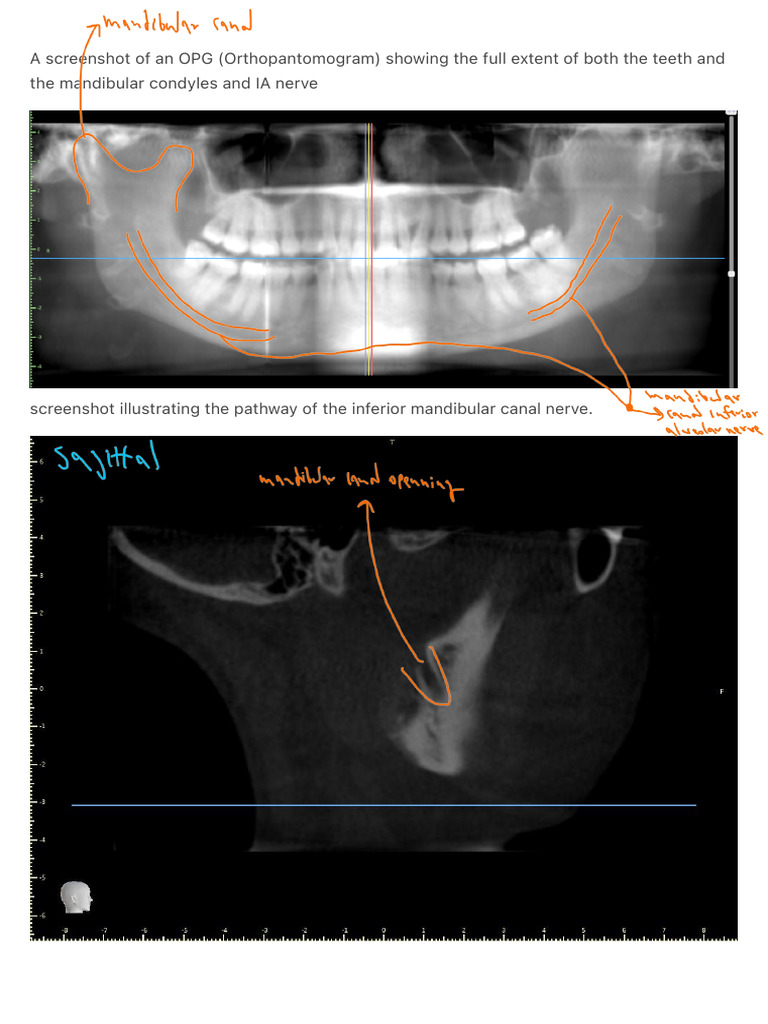OPG Analysis: Teeth, Nerves, and Sinuses | PDF