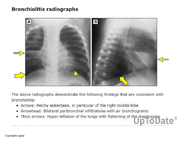 Bronchiolitis Radiograph | PDF